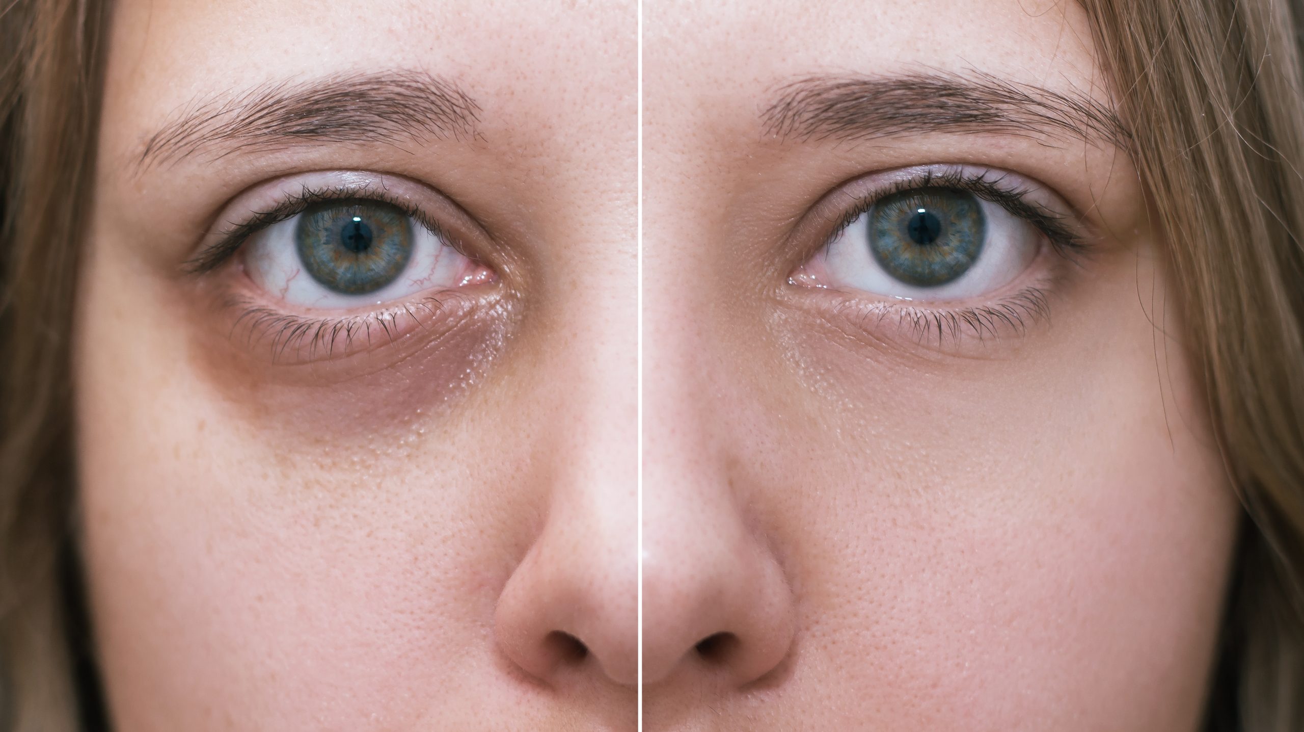 Under Eye Fillers
